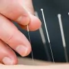 AQure Acupuncture